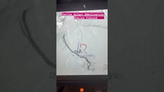 Uterine Fibroids Embolization  Uterine Fibroids  Uterine Fibroids Treatment [upl. by Auqemahs]