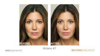 Radiesse® and Belotero Balance® at Boynton Plastic Surgery [upl. by Arras]