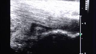 UltrasoundGuided Injection of Retrocalcaneal Bursitis [upl. by Abihsat]