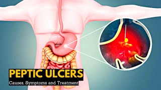 Peptic Ulcers Causes Signs and Symptoms Diagnosis and Treatment [upl. by Nyrol]