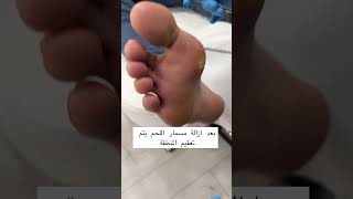 pedicure treatment men health feet clinic podologia [upl. by Secnarfyram]