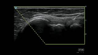 Elbow Ultrasound Lateral Epicondyle Injection [upl. by Valina420]