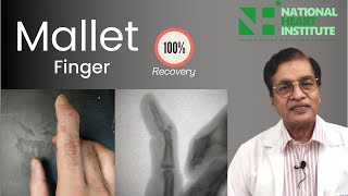 Mallet Finger Treatment In Hindi Dr Karoon Agrawal [upl. by Armbrecht]