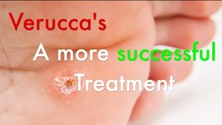 How Swift Verruca Treatment Works [upl. by Nancee627]