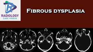 Fibrous dysplasia [upl. by Egas]