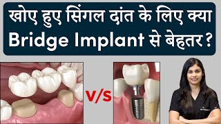 खोए हुए सिंगल दांत के लिए क्या बेहतर Bridge या Implant  Dr Vishakha Jain  Seraphic Dental Indore [upl. by Kered259]