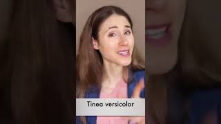 Top 5 Home Remedies for Tinea Versicolor shorts [upl. by Bogart]