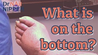 Can lymphedema go away Toenails Lymphedema Athletes Foot Friday Feature Replay 2021 [upl. by Karas]