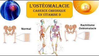 LOSTEOMALACIE🦴  la CARENCE en VITAMINE D ☀️ [upl. by Chlores794]