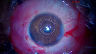 Dr Sourabh Patwardhan Live Cataract surgery For training and consultation call 7028402375 [upl. by Nwavahs]