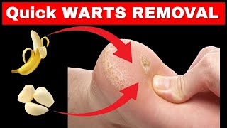 Wart Removal How to get rid of plantar warts PERMANENTLY at Home [upl. by Jaymie738]