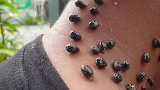 Easy and Safety Way To Remove All Big Ticks Human neck [upl. by Line239]