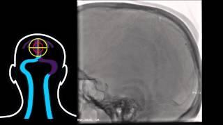 Interventional Stroke Rounds  Venous Sinus Thrombosis [upl. by Suiram]