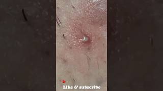 Ingrown infected removal [upl. by Burget]