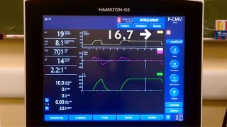 Compliance measurement during pressure control ventilation [upl. by Ettennor]