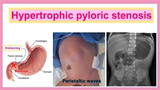 hypertrophic pyloric stenosis [upl. by Dorsy189]