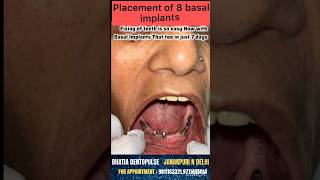 Now fixing new teeth is possible in just 7 days with basal implants basalimplants [upl. by Asiret312]