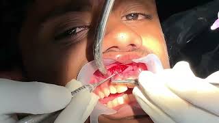 Maxillary tooth apicectomy  curettage and retrograde obturation [upl. by Goodard]