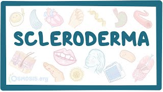 Scleroderma  an Osmosis Preview [upl. by Colleen903]