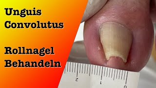 Unguis Convolututs Rollnagel Behandlung 1  podologinandrea [upl. by Hareehat]