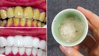 En 2 Minutes  Transformez Les Dents Jaunes En Blanc Naturel Avec Seulement Ces 4 Ingrédients [upl. by Airamalegna301]