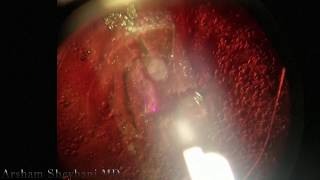 Arsham Sheybani MD Performs YAG Capsulotomy [upl. by Con]