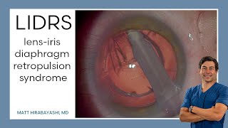 LIDRS lensiris diaphragm retropulsion syndrome Explanation and Demonstration [upl. by Yoo]