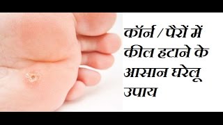 Corn ka ilaj in hindi Corn Removal Home Remedies Corn Home Treatment Corn ka Gharelu Ilaj Gokhru [upl. by Giacobo]