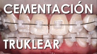 CEMENTACIÓN BRACKETS DE AUTOLIGADO CERÁMICOS  Ventajas y Desventajas [upl. by Alled561]