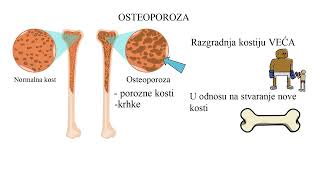 OSTEOPOROZA šta je i kako nastaje [upl. by Terris]