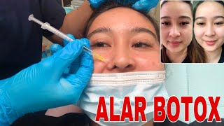 PROCEDURE FOR ALAR BOTOX 3RD TIME [upl. by Acirne]