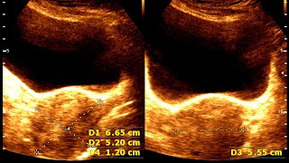 Retroverted uterus  Uterine prolapsed  Ultrasound cases 511 of 2000 [upl. by Aicsila]