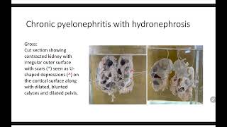 GROSS PATHOLOGY OF CHRONIC PYELONEPHRITIS [upl. by Einnaej]