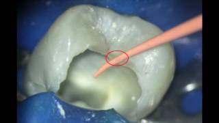 25 Acute Apical Periodontitis RCT [upl. by Aleyak577]