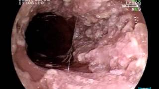 Endoscopic Imaging of Esophageal Verrucous Carcinoma [upl. by Fillian477]