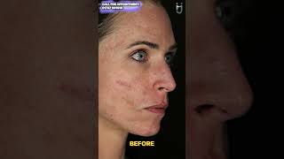 Acne Scar Treatment [upl. by Nomahs]