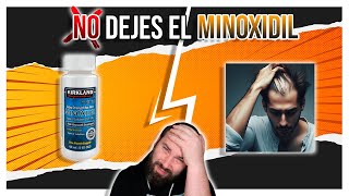 ESTO es lo que PASA si DEJAS MINOXIDIL [upl. by Latashia]