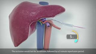 Segment 7partial segment 8 liver resection for HCC [upl. by Sivolc470]