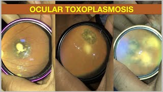 Ocular Toxoplasmosis  Retinochorioditis [upl. by Javed]