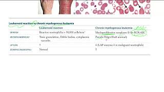 42 Leukemoid reaction vs chronic myelogenous leukemia [upl. by Brad777]