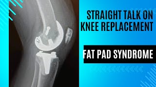 Straight Talk on Knee Replacement  Fat Pad Syndrome [upl. by Cord]