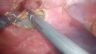 hydatid cyst surgery at Bombay hospital Indore [upl. by Meer]