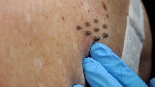 Extreme Blackhead Removal by Hand 2024 [upl. by Eylloh]