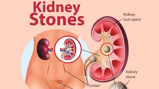 what are causes of kidney stones   Dr JANANI [upl. by Divadnoj]