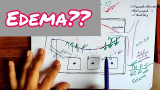 Edema  Physiology of Edema  Mechanism of Edema  Bangla Demonstration of Edema  Edema Physiology [upl. by Harrison342]