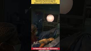 Operative Hysteroscopy for Uterus with Endometrial Polyps by Dr Rakshita Malik doctor mbbs ivf [upl. by Ayotahc]