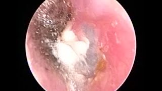 Otoendoscopy  Fungal infection in mother ear after trauma [upl. by Klemperer]