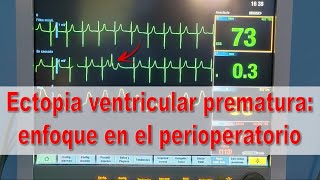 Ectopias ventriculares prematuras enfoque en el perioperatorio [upl. by Domel]