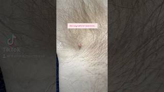 Skin Tag Removal before and after results skintagremoval [upl. by Yajeet539]