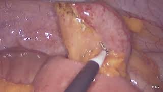 Laparoscopic appendectomy unedited 882024 [upl. by Ardelia457]